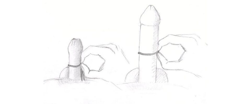 Medición del grosor del pene